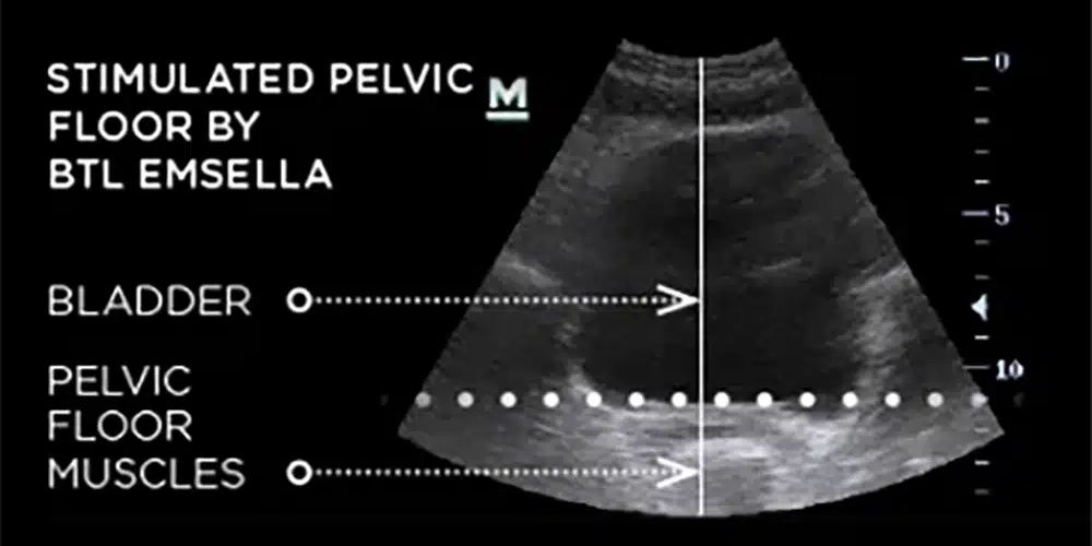 Pain Management Spring Grove IL Stimulated Pelvic Floor